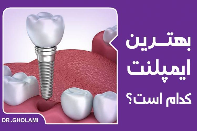 بهترین ایمپلنت دندان کدام است؟