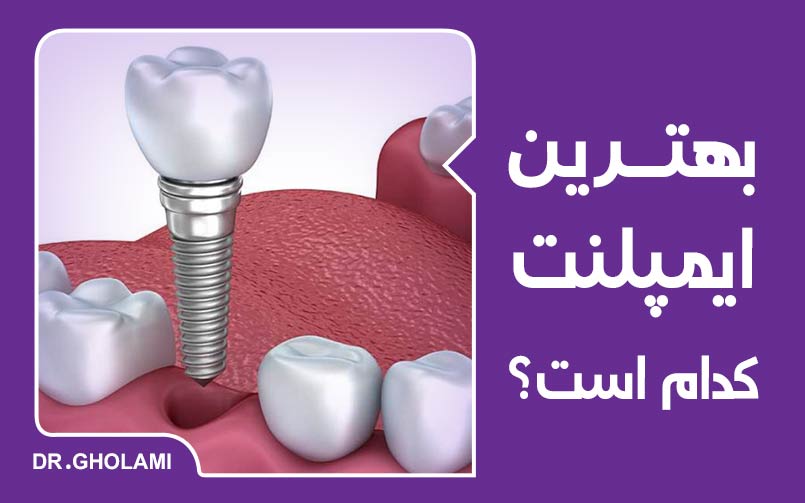 بهترین ایمپلنت دندان کدام است؟