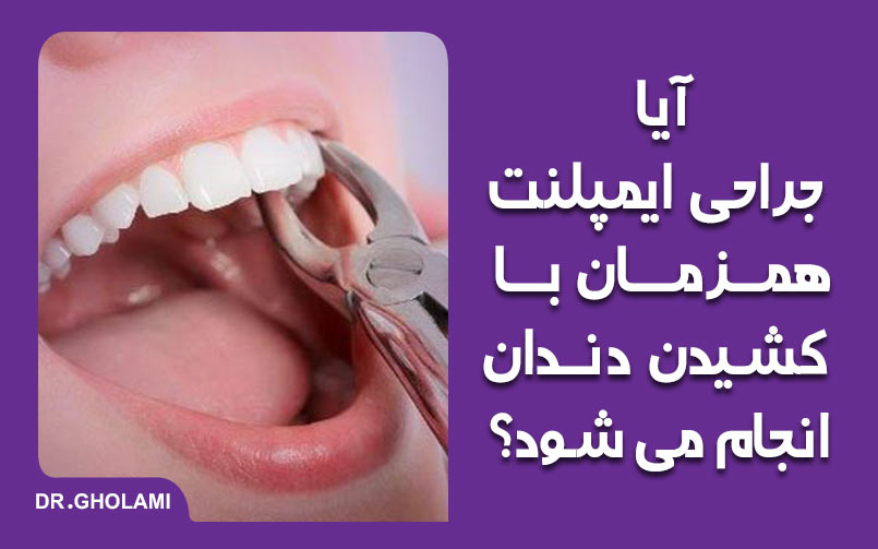 جراحی ایمپلنت همراه با کشیدن دندان در مشهد