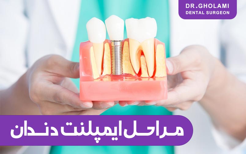 مراحل ایمپلنت دندان (مشهد)