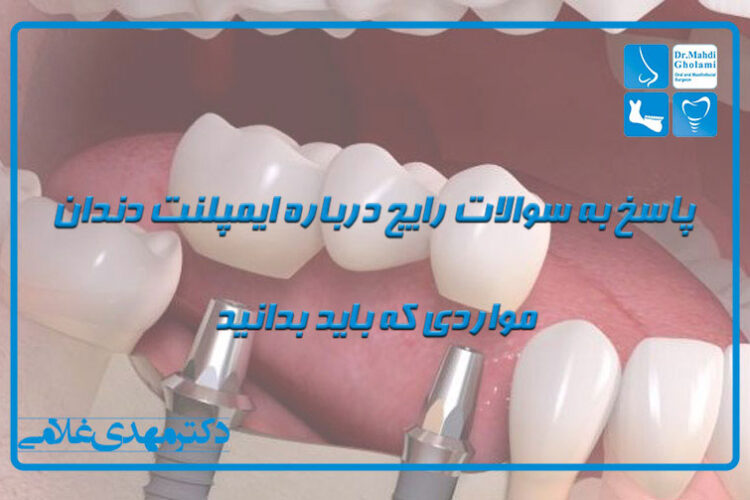 پاسخ به سوالات رایج درمورد ایمپلنت دندان