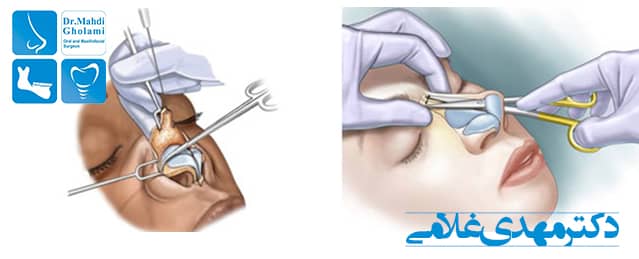 جراحی بینی استخوانی در مشهد